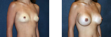 328_breast1 328_breast1