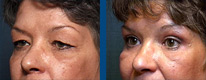 eye_lift1_thumb eye_lift1_thumb