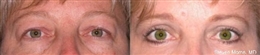 eyelid_thumb eyelid_thumb